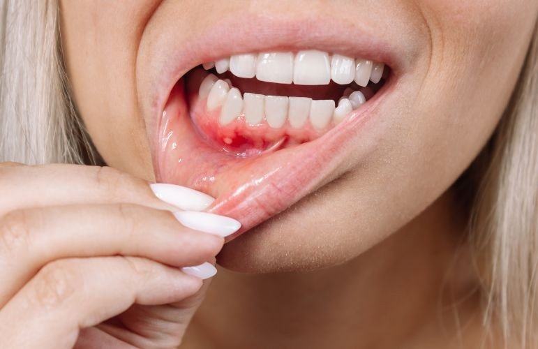 Treatment of Bleeding Gums Awadhpuri Bhopal