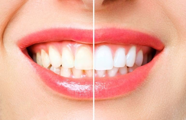 Teeth Whitening & Bleaching Awadhpuri in Bhopal