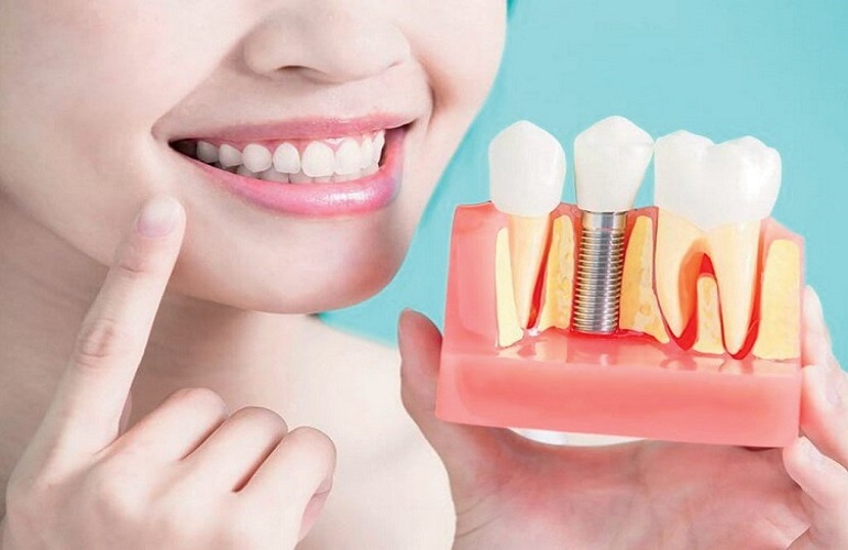 Dental Implants Service in Awadhpuri Bhopal