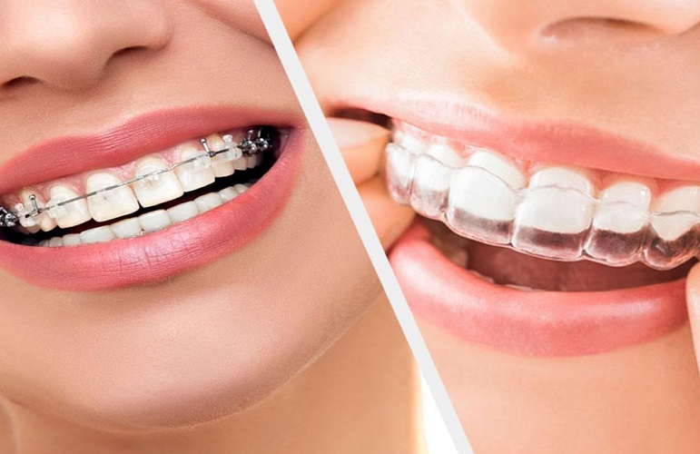 Orthodontics Treatment Awadhpuri Bhopal